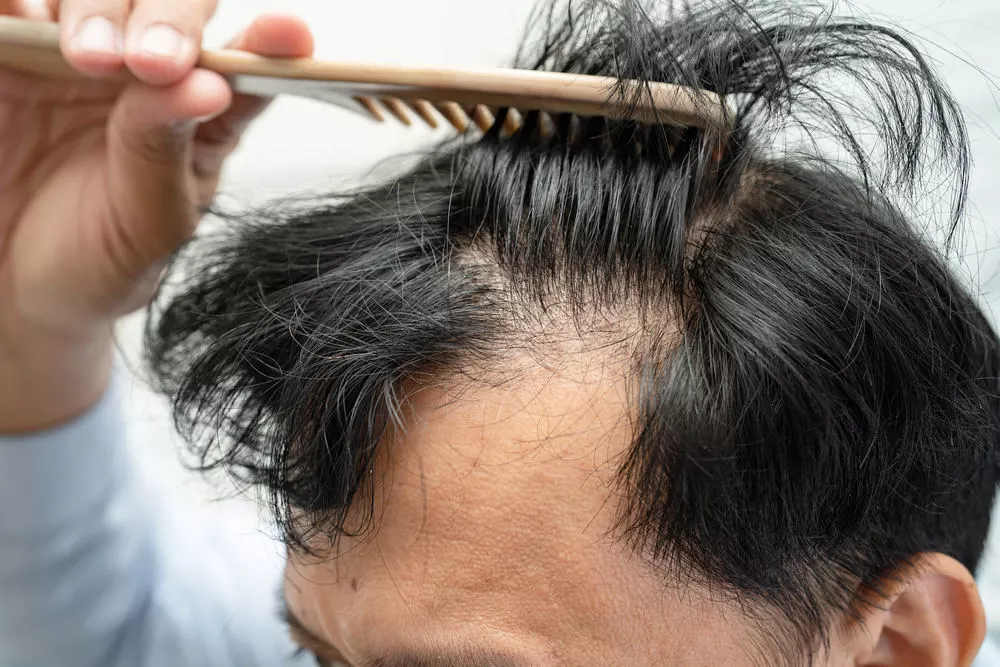 Changes in hair (Hairfall)